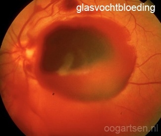 Een voorbeeld van een glasvochtbloeding (de oogzenuw en bloedvaten schemeren door):