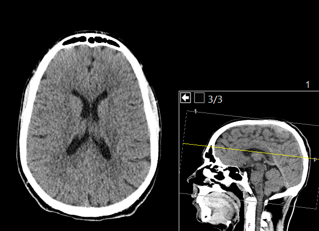 By Mikael Häggström, M.D.- Author info- Reusing imagesWritten informed consent was obtained from the individual, including online publication. - Own work, CC0