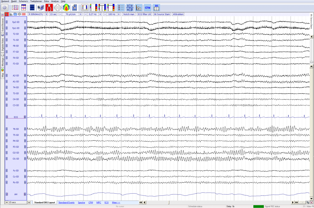 normaal EEG in source montage
