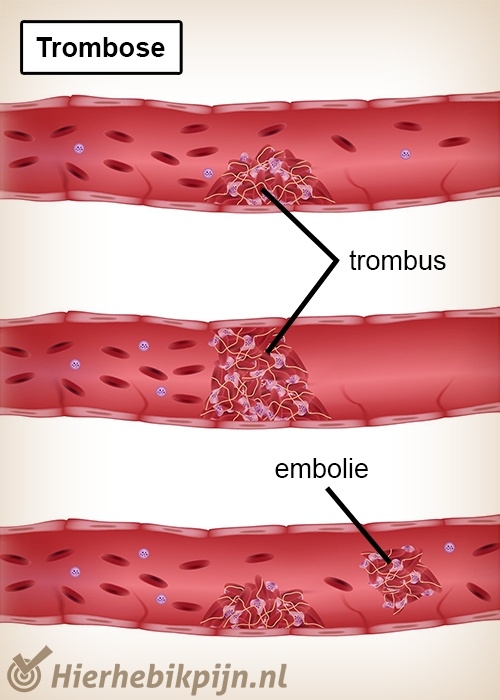 Trombose en Embolie