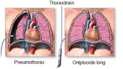 bron: https://klaplong (pneumothorax)-Medkennis.nl