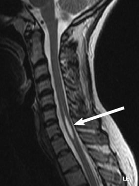 Syringomyelie. Bron: Wikimedia Commons