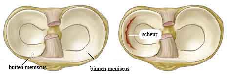 gescheurde meniscus