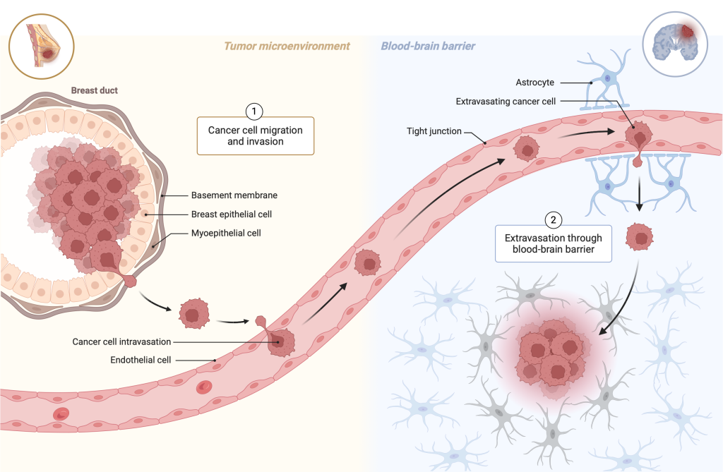 Figure 9.2 Metastatic process. The primary tumour arises in the mammary ducts of the breast. The cells of the mammary gland epithelium are separated from the surrounding ligament by a basement membrane. The tumour cells penetrate this, mechanically enter the blood vessel through the wall, and are carried away by the body. At some point, they attach to the blood vessel wall and migrate the other way to another tissue, for example, the brain. There they attach and form a micrometastasis, in which division continues until a metastasis has formed.