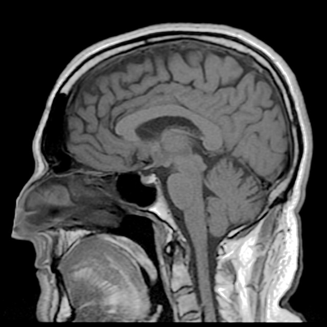 MRI brein - normaal. Bron: Wikimedia Commons