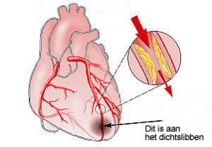 Zo ziet je hart eruit tijdens een hartaanval