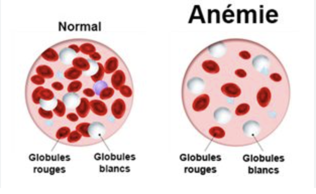 Hoe ziet  anemie eruit?