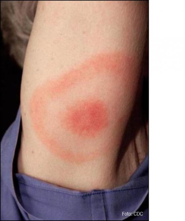 Een voorbeeld van de Erythema migrans, de rode ring die wijst op een besmetting met de ziekte van Lyme. 