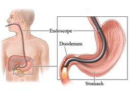 Endoscopie van de maag