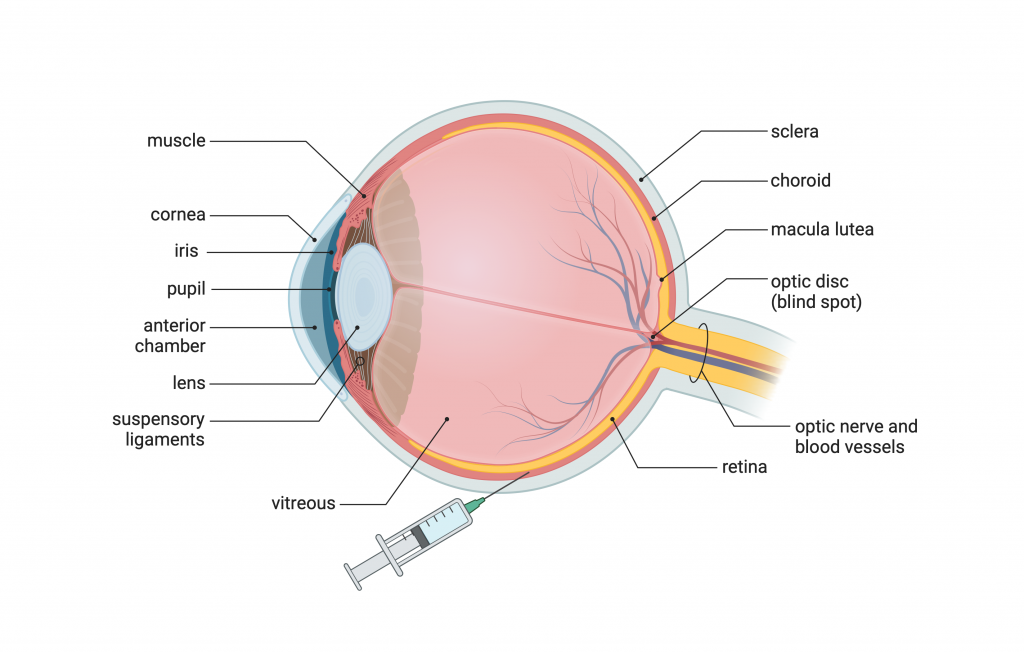 Figure 10.6 Gene therapy in the treatment of visual impairments. The drug is injected into the space between the retina and the choroid.