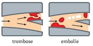 Trombose en Embolie