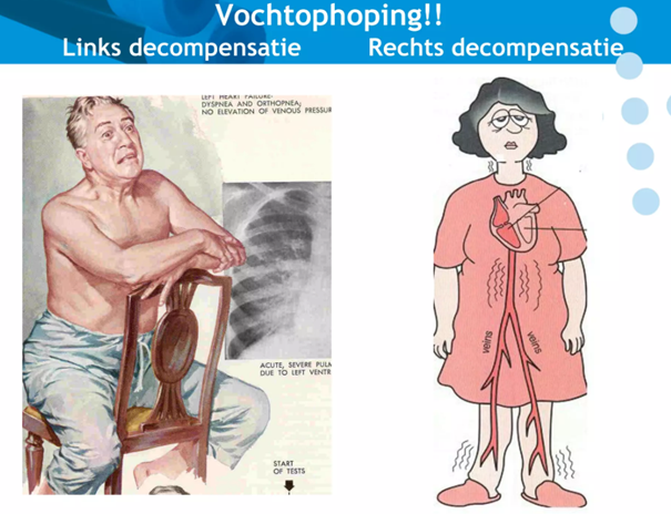 Links: stuwing in longen, rechts: stuwing in onderlichaam