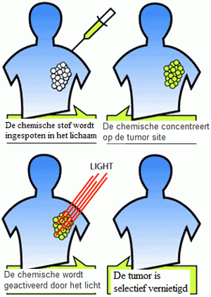 Fotodynamische therapie. Deze therapie word niet veel gebruikt.