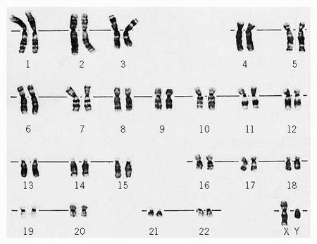 Karyogram (plaatje met chromosomen paren)
