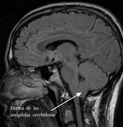 Type 1 Chiari malformatie. Bron: Wikimedia Commons