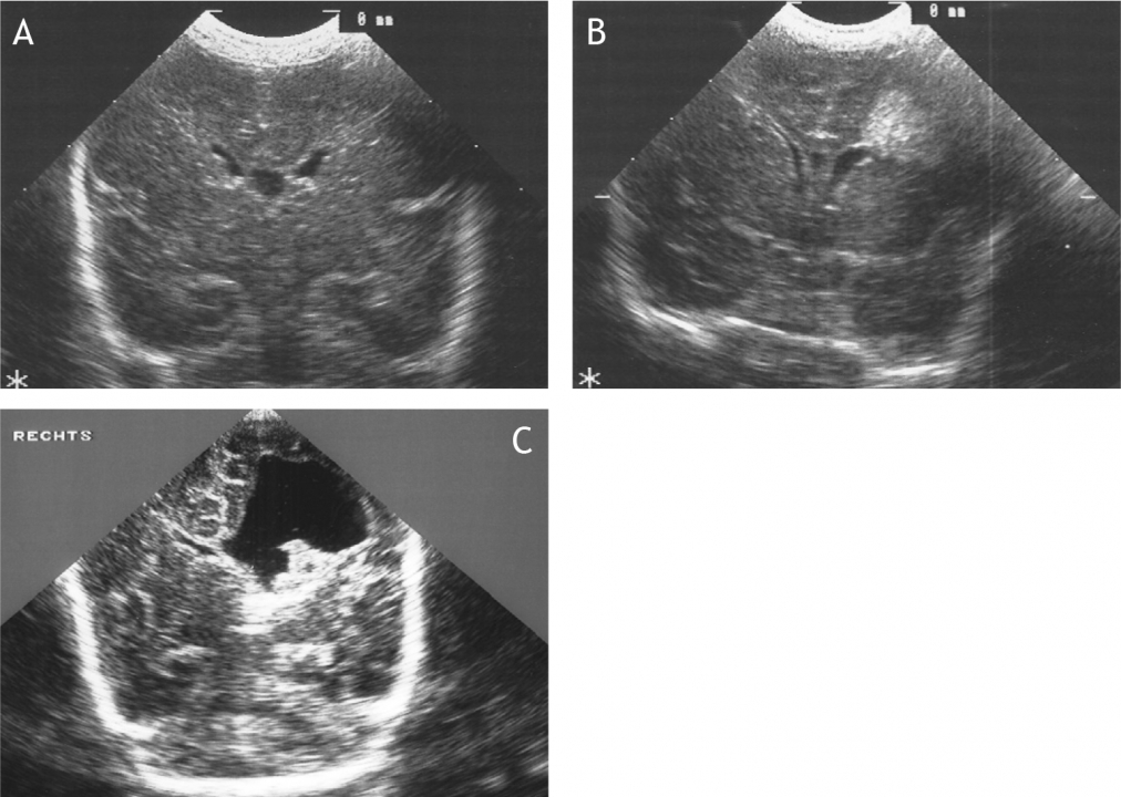 Figuur 11.2 Ultrageluidsopnamen van de hersenen: (A) normale hersenen van een vroeggeborene (B) periventriculair infarct bij vroeggeborene (C) porencefale cyste.
