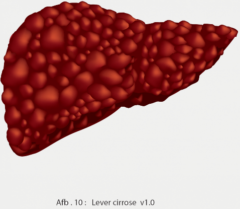 Afb. 4 Een lever met levercirrose