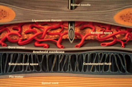 Epiduraal anesthesie