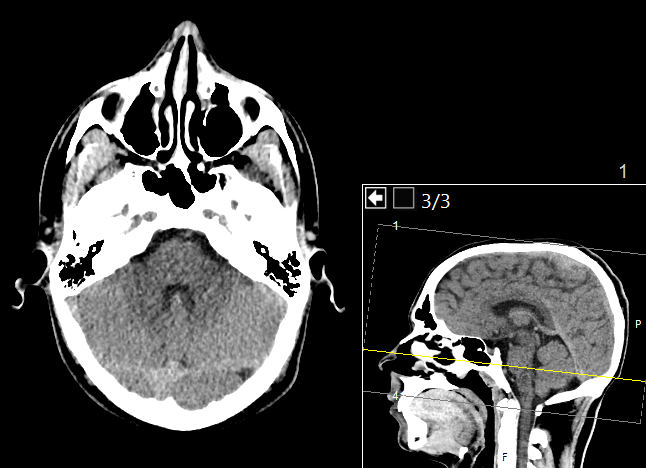 By Mikael Häggström, M.D.- Author info- Reusing imagesWritten informed consent was obtained from the individual, including online publication. - Own work, CC0 