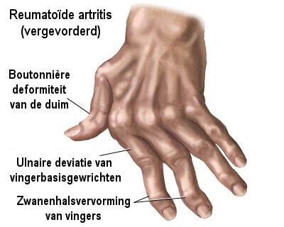 reumatisch atritis