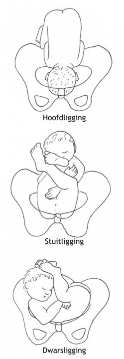 Figuur 9.1 Posities van de foetus aan het begin van de partus.