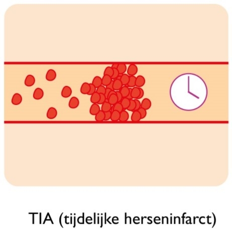 TIA is een tijdelijke verstopping van de bloedcirculatie