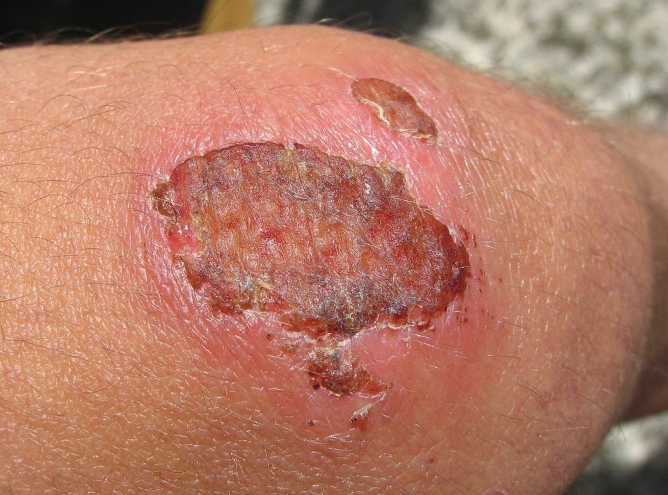 Afbeelding 9 - http://www.healthhype.com/scab-formation-process-causes-pictures-care.html