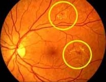 Diabetische Retinopathie