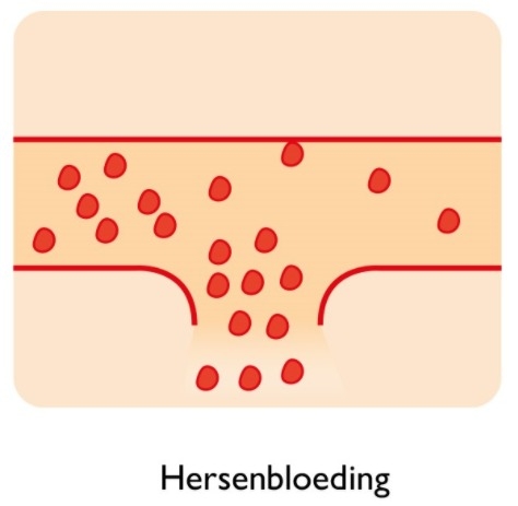 Een hersenbloeding is een lekkage van het bloedvat, waardoor de bloedcirculatie wordt verstoord