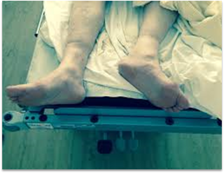 Duidelijk beenlengte verschil