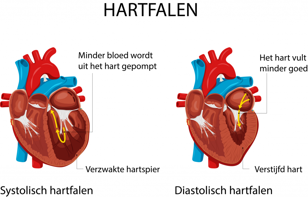 Diastolisch en Systolisch hartfalen