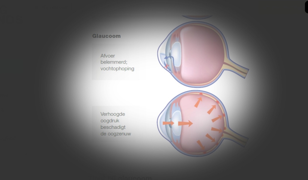 Dit ziet een patiënt met glaucoom