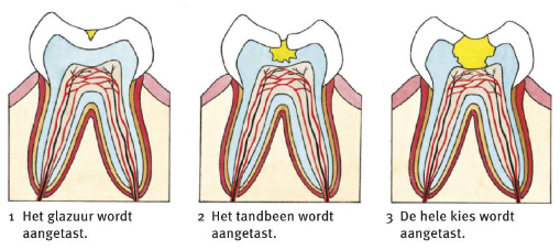 Drie fasen van aantasting van een kies