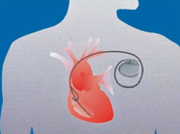 figuur 1. Pacemaker in lichaam