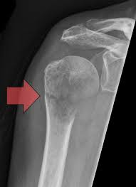 Metastase (uitzaaiing) in de humerus