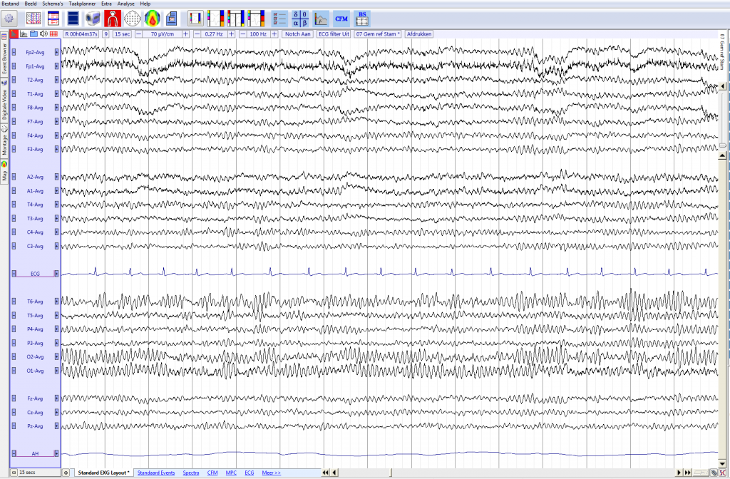 normaal EEG in gemiddelde montage