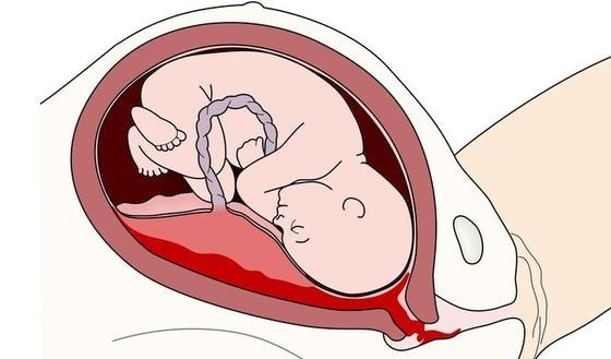 Solutio placenta