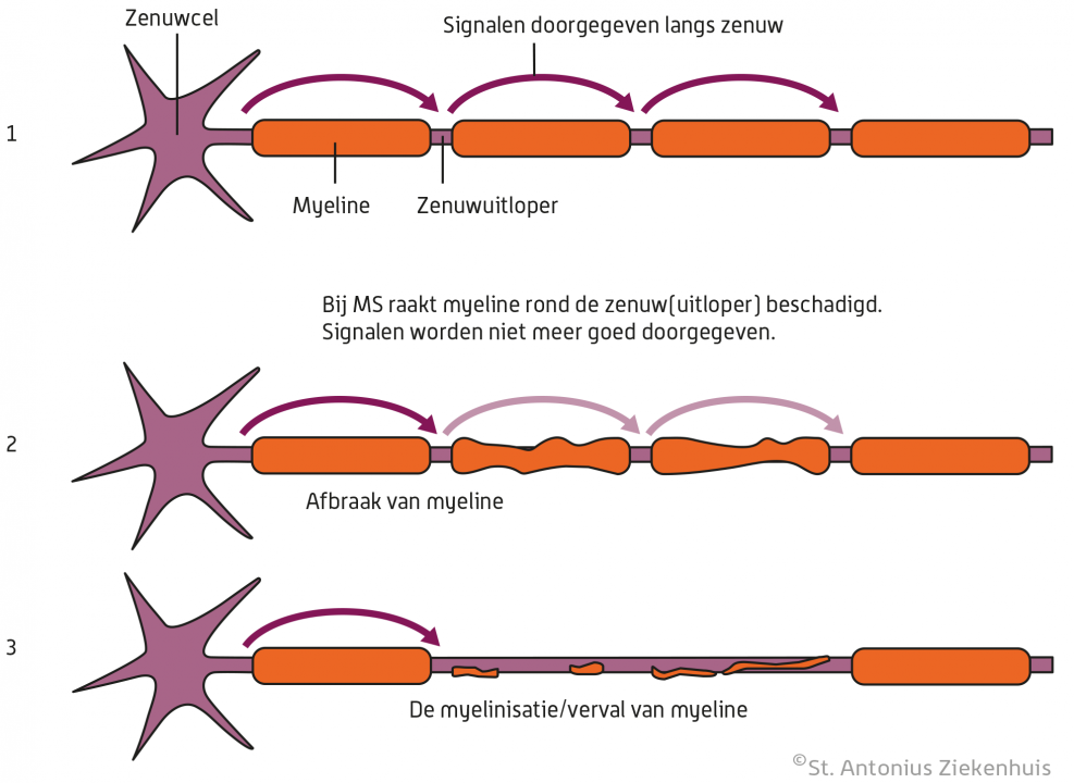 Bron afbeelding: St. Antoniusziekenhuis