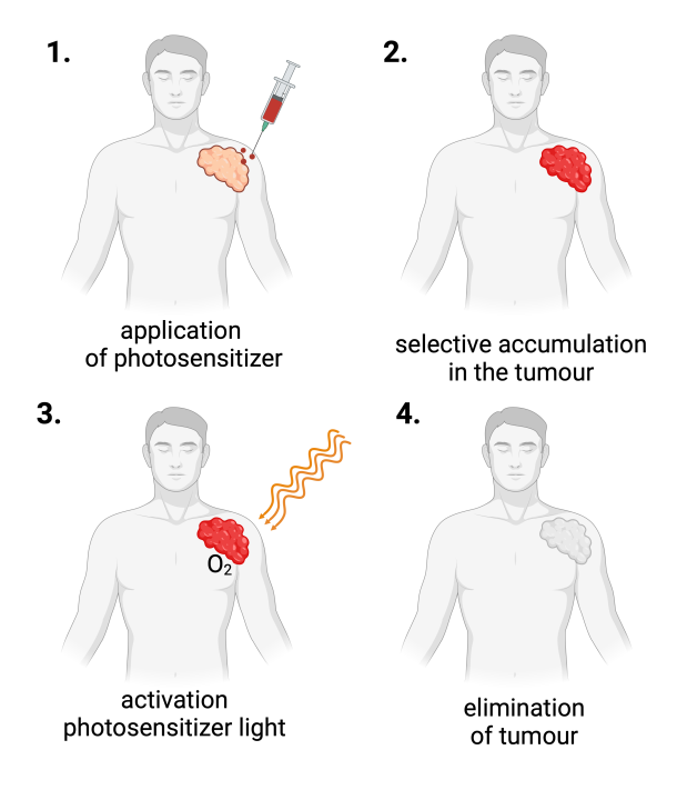 Figure 11.4 Scheme of photodynamic therapy in the treatment of tumours. 1: The application of a photosensitiser, such as  hypericin. 2: There is selective accumulation of the photosensitser in the tumour cells. 3: Activation of the photosensitiser using light. 4: Finally the tumour is eliminated.