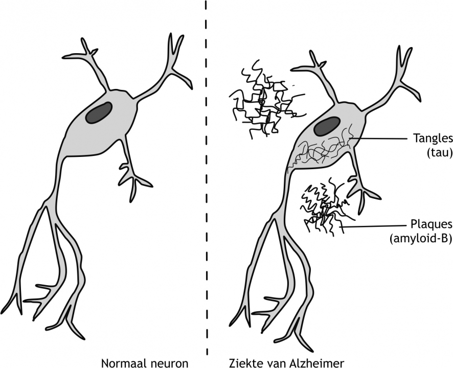 Figuur 21.1 Intracellulaire tangles en extracellulaire plaques in de ziekte van Alzheimer