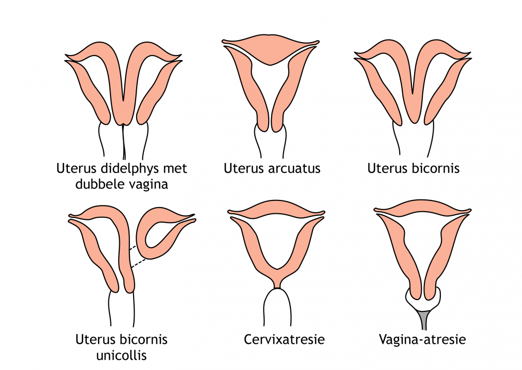 Figuur 14.5  Uterus- en vaginadefecten/-anomalieën. Ontleend aan: Sadler TW. Langman’s Medical Embryology. Twaalfde druk. Philadelphia PA, Lippincott Williams & Wilkins (2012).