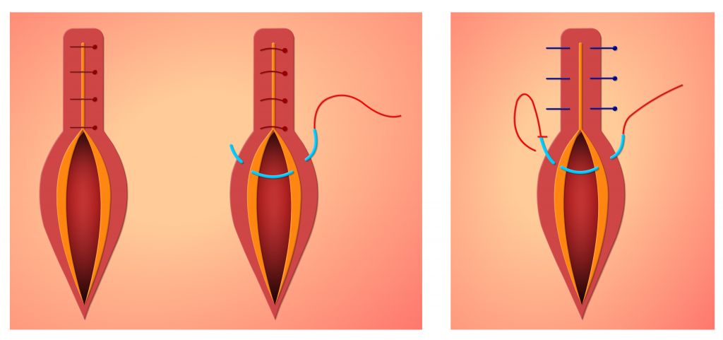 Enkelvoudige hechting (links) en individueel geknoopte verticale matrashechting (rechts).