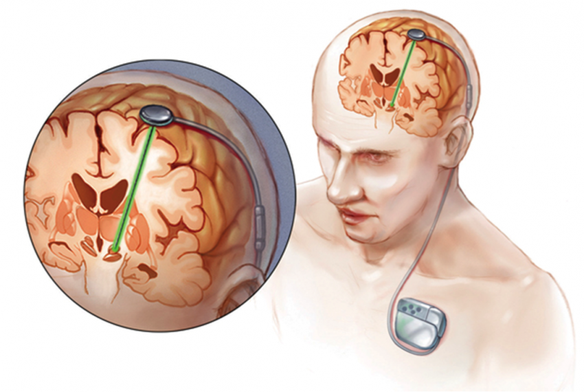 Bron afbeelding: www.deepbrainstimulation.mumc.nl