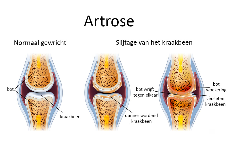 Doorsnede van een gezond gewricht vs een gewricht met artrose: