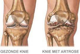 Artrose als ouderdomsverschijnsel, in de knie: