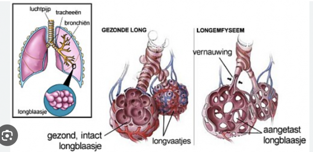 Hoe ziet de longemfyseem eruit?