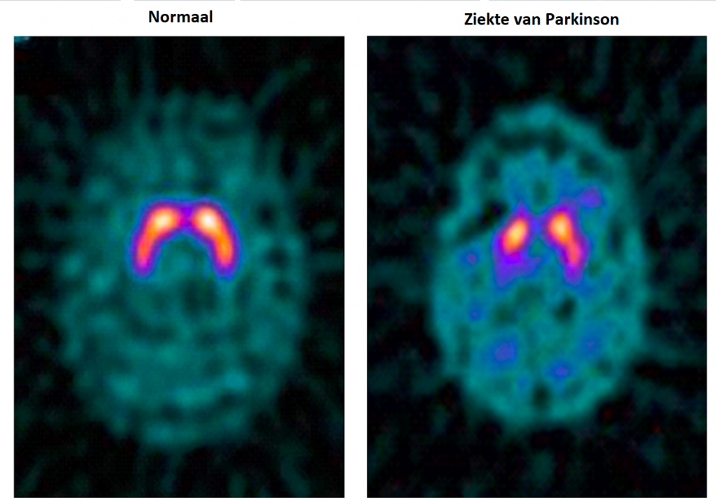 SPECT (DAT) scan bij de ziekte van Parkinson. Rechts minder uptake van dopamine in de kernen (basale ganglia) van de hersenen.