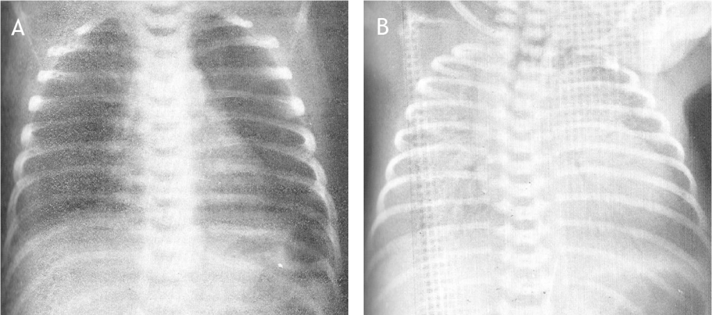Figuur 11.1 Röntgenfoto’s van de longen: (A) normale luchthoudende longen (B) respiratory distress syndrome (RDS).