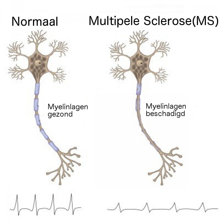 een voorbeeld is m.s.(multiple sclerose)