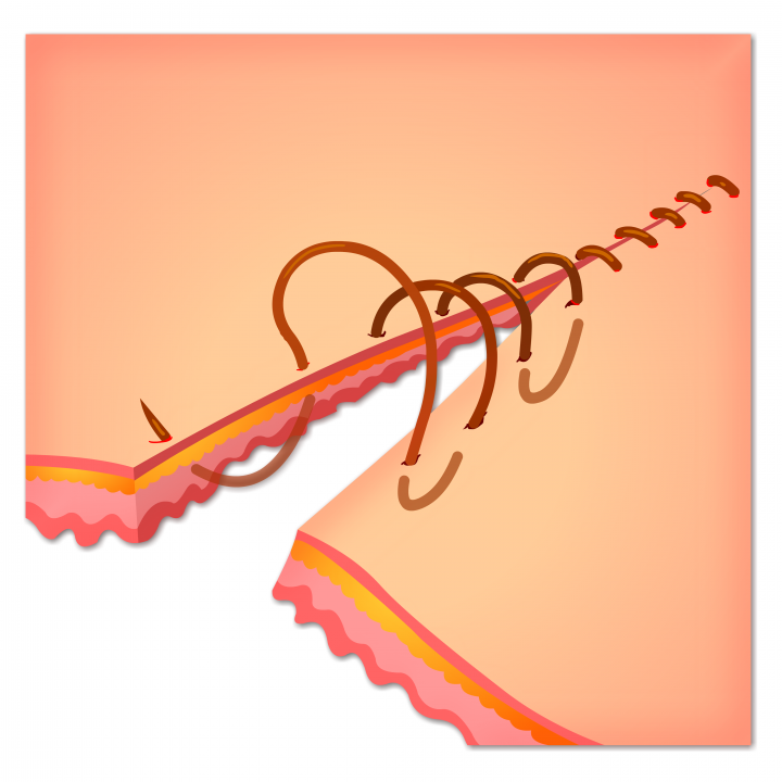 Doorlopende intracutane matrashechting.